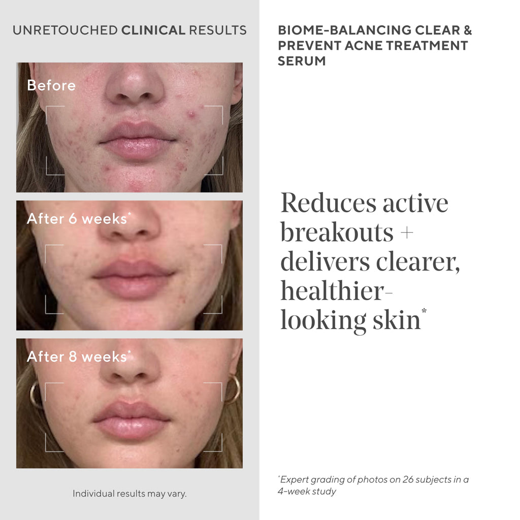 Murad Acne Dual Treatment Combo - Deep Relief and Biome-Balancing Spot Treatments with Triple Acids and Phytosteroids for Maximum Strength Clearing and Preventing Deep Painful Breakouts, Set of 2