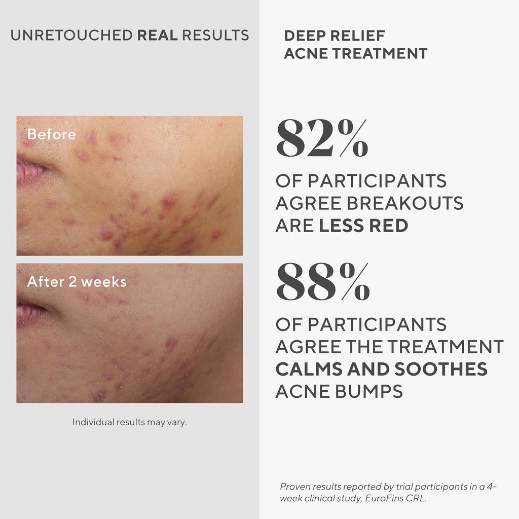 Murad Acne Dual Treatment Combo - Deep Relief and Biome-Balancing Spot Treatments with Triple Acids and Phytosteroids for Maximum Strength Clearing and Preventing Deep Painful Breakouts, Set of 2