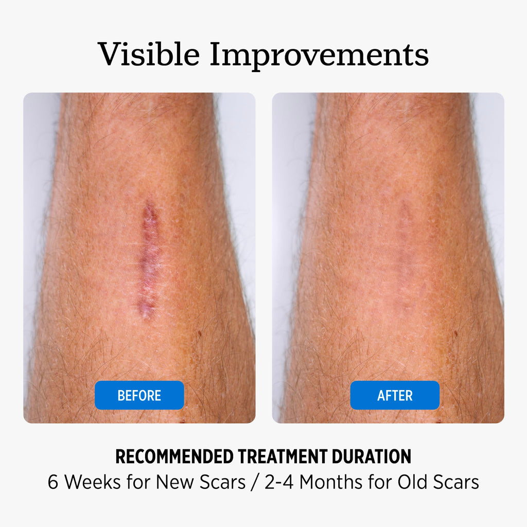 NUVADERMIS Clear Silicone Scar Tape for Surgical Scars